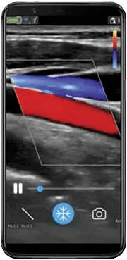 Linear Ultrasound Maverick Equipment: GE Vscan Air CL