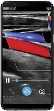 Linear Ultrasound Maverick Equipment: GE Vscan Air CL