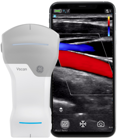 Vscan Air Carotid Artery Vscan Air Carotid Artery